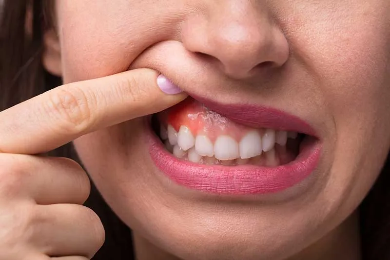 Cover for Causes of Gum Pain and When to See a Dentist