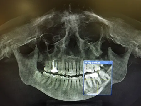 Cover for How Often Do You Need Dental X-Rays?