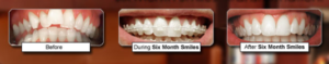 six month smiles adult braces