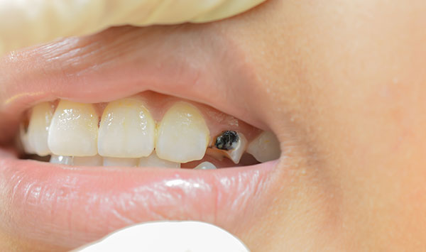 black-teeth-causes-and-treatment-to-handle-the-problem