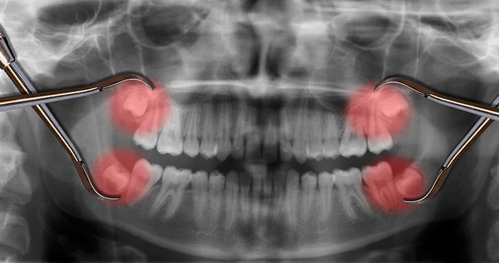 Wisdom-teeth-extraction
