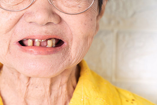 Tooth-loss-connected-with-dementia