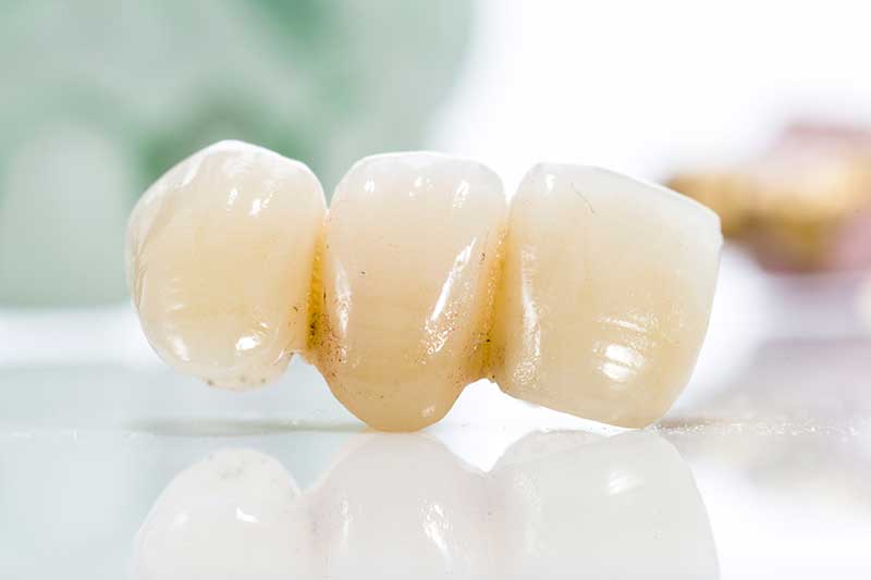 Loose Dental Crown is It An Urgent Matter 