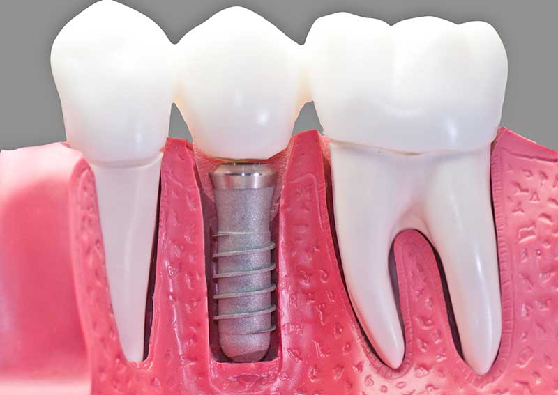 Questions-about-Dental-Implants
