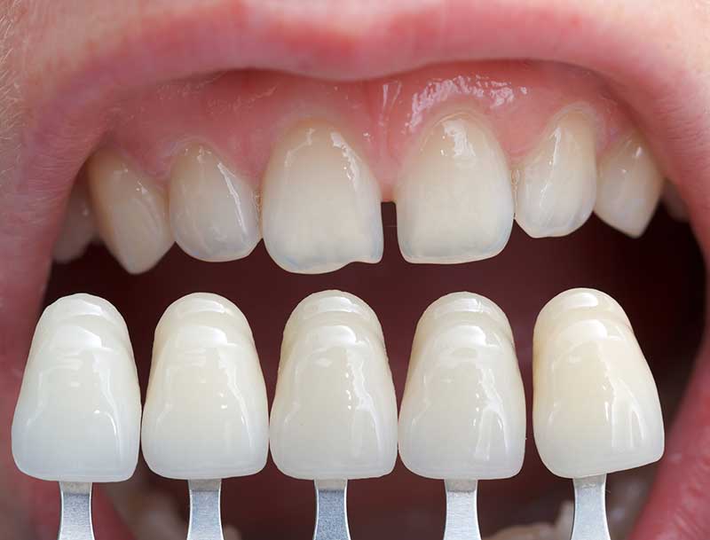 good-oral-hygiene-for-dental-veneers