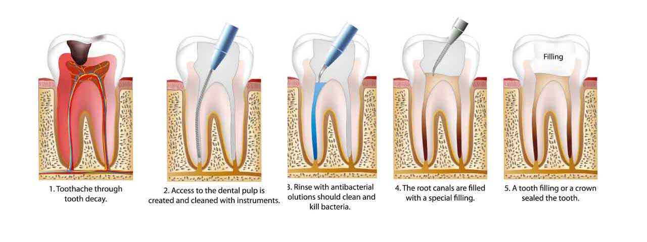 Teeth-with-root-canals
